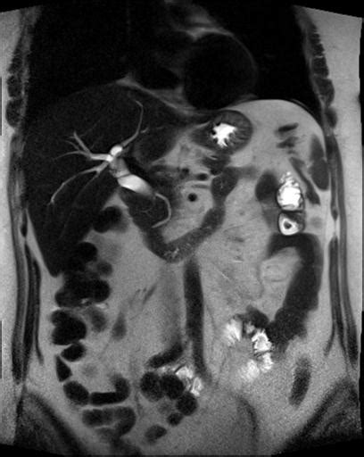 Mesenteric Panniculitis Image