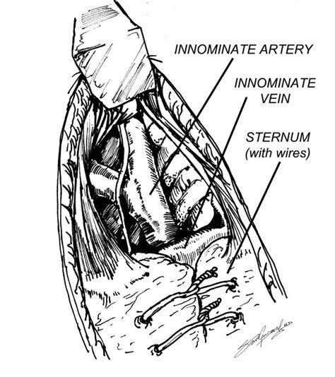 Dissection of innominate artery cephalad to innominate vein. | Download ...