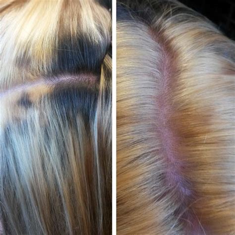 Hair Bleach Chemical Burn