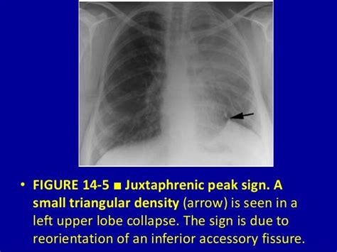 Pulmonary Lobar Collapsevessential Considerations 14 Dr Muhammad Bi