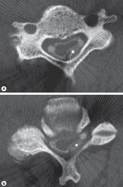 Figure 2 from Cervical Myelopathy due to an Epidural Cervical Mass ...