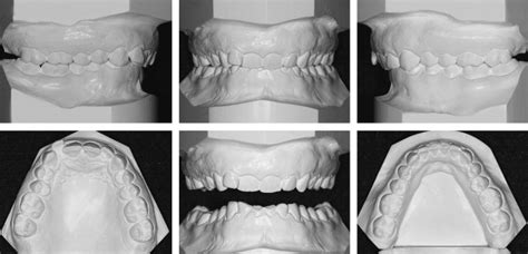 Mandibular “tripod” Advancement Of A Class Ii Division 2 Deepbite Malocclusion Pocket Dentistry