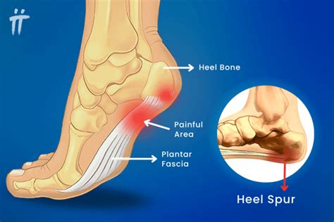 What Is Heel Spur Symptoms Diagnosis And Treatment Turan Turan