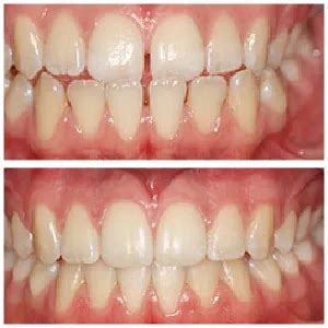 Teeth Braces Cost Types By Dental Clinic Karachi Side Effects