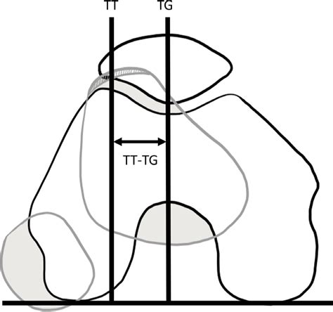 Tibial Tuberosity Trochlear Groove Distance Does It Measure Up Bone