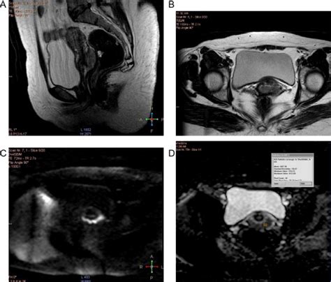 37years Old Female With Cervical Carcinoma Figo Stage Ib2 A And B Download Scientific