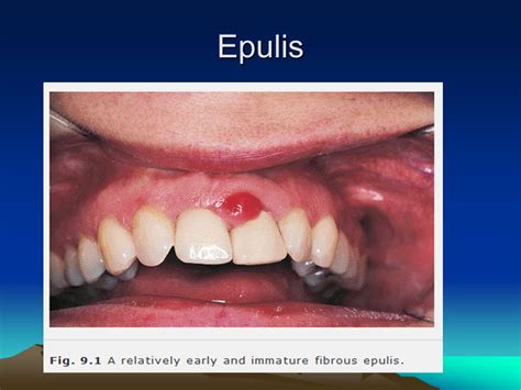 Inflammatory Overgrowths Ppt Download