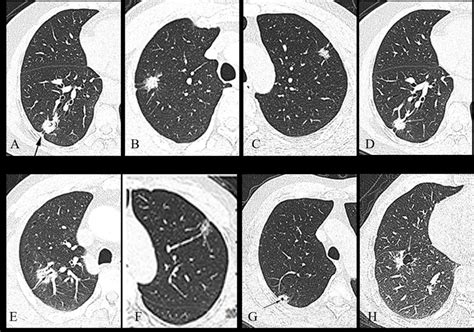 Display of common malignant signs: (A) pleura traction sign (black ...