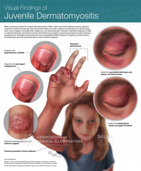 Visual Findings In Juvenile Dermatomyositis Ami Cleveland