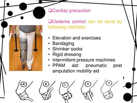 Amputation Stump Care Phantom Limb Pain And Gait Training In Lower L