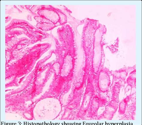 Figure From An Unusual Cause Of Anasarca A Paediatric Case Report