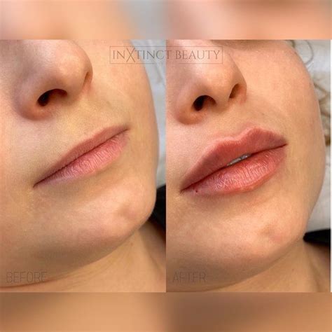 Lip Filler 1ml Artofit