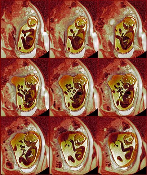 9 Month Foetus Mri Scans Photograph By Du Cane Medical Imaging Ltd