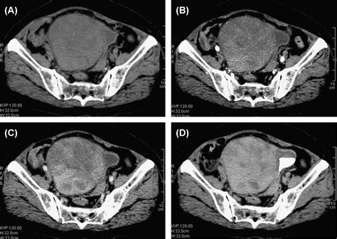 Computed Tomography And Magnetic Resonance Imaging Findings Of Solitary