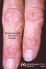 Gottrons Papules