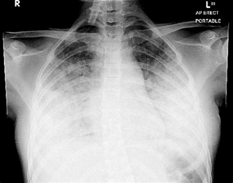 Diffuse Alveolar Hemorrhage, Pulmonary capillaritis - Dermatology Advisor