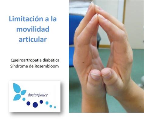 Limitación a la movilidad articular LMA Clínica Reumatológica Dr Ponce