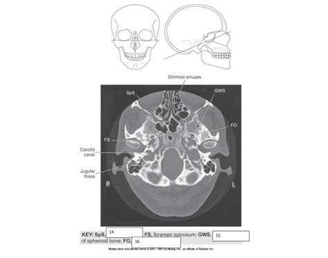 Axial CT of Sphenoid bone w/ FO and spinosum Quiz