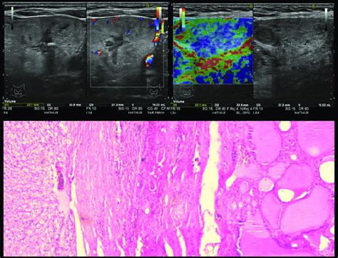 Upper images-thyroid ultrasound: Heterogeneous appearance with cystic ...