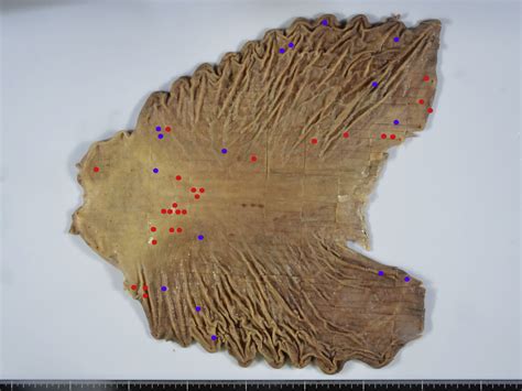 Detection Of Multiple Intramucosal Signet Ring Cell Carcinomas By White