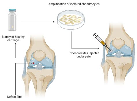 Cells Free Full Text Chondrocyte De Differentiation Biophysical