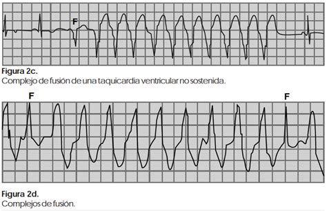 Ecg 78 Arritmias Ventriculares Cardio Science