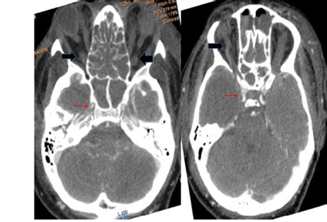 Axial Ct Angiography Showing Normal Enhacement Of Cavernous Carotid Hot Sex Picture