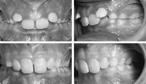 Dental Arch Width In Class Ii Division 2 Deep Bite Malocclusion American Journal Of