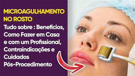 Tudo Sobre Microagulhamento No Rosto Benef Cios Como Fazer Em Casa E