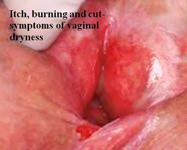 Why Is My Vagina Itchy After Sex