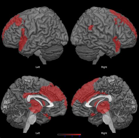 Frontiers Reduced Phonemic Fluency In Progressive Supranuclear Palsy Is Due To Dysfunction Of