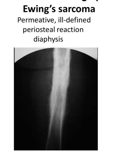 Pathology Of Bone Cartilage Tumors Msk Exam Flashcards Quizlet