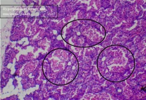 Histological Section Of The Breast Tissue Of Dmba Induced Breast Cancer