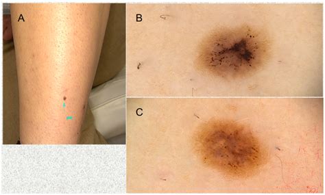 Life Free Full Text Clinical And Dermoscopic Findings Of Nevi After