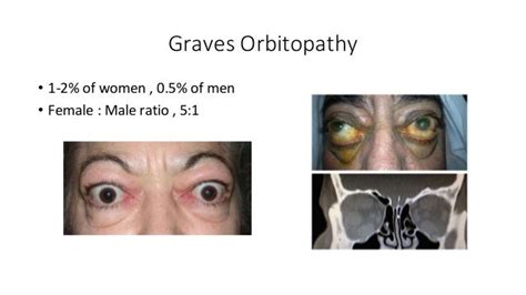 Graves Orbitopathy