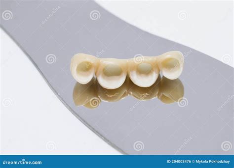 Metal Free Ceramic Dental Crowns Dental Ceramic Veneers And Crowns