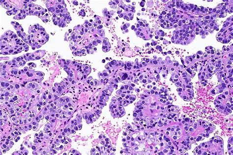 Clear cell carcinoma (uterus) - MyPathologyReport.ca