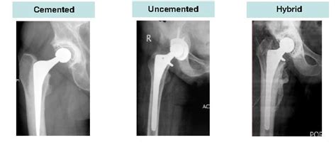 WHAT ARE THE TYPES OF ARTIFICIAL HIP JOINTS? | Dr. Shekhar Agarwal