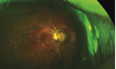 peripapillary_atrophy - Review of Myopia Management