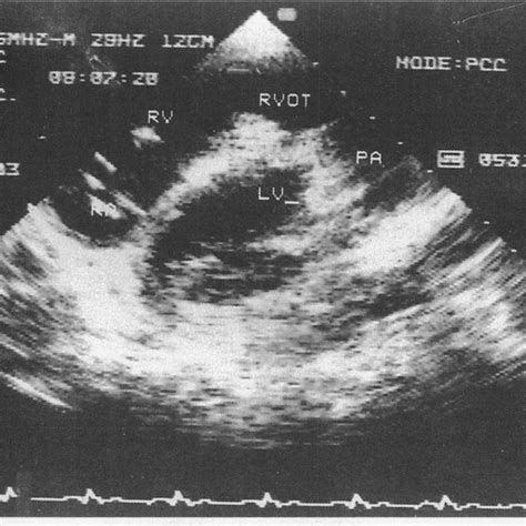 Angiogram Of The Right Ventricular Outflow Tract Pulmonary Arteries In