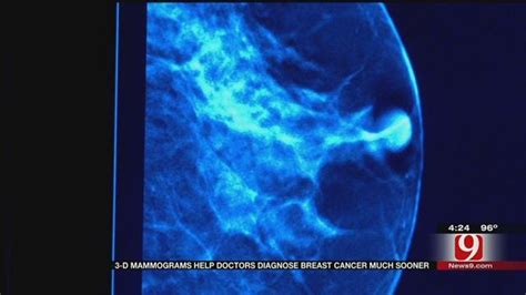 Medical Minute 3d Mammograms