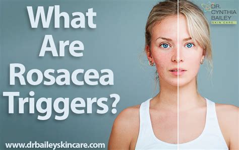 Rosacea Triggers – TUTORING YOU