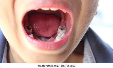 Children Tooth Decay Because They Do Stock Photo 1077356603 | Shutterstock