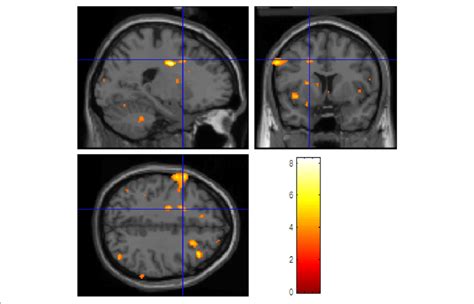 Brain Fmri Scan