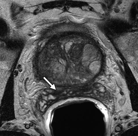 Seminal Vesicle Invasion In Prostate Cancer Evaluation By Using