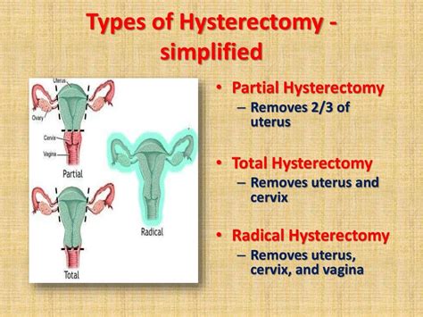 Hysterectomy