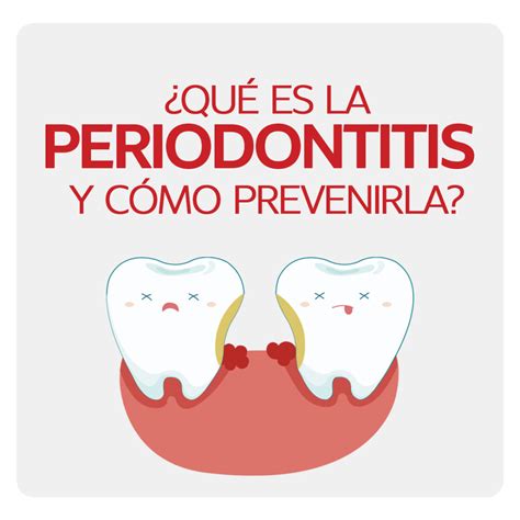 Qu Es La Periodontitis Y C Mo Prevenirla Phb