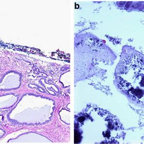 (PDF) Interobserver reproducibility in the diagnosis of flat epithelial atypia of the breast