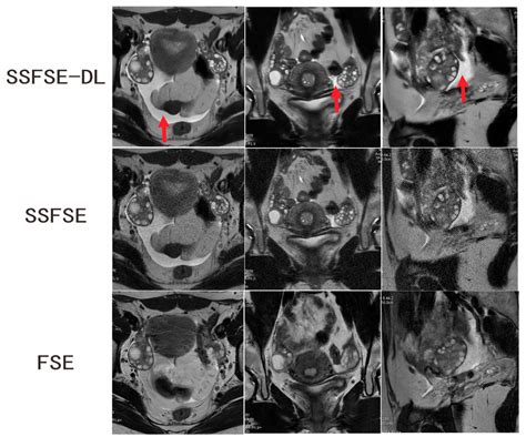 Ovarian MRI in a 16-year-old adolescent girl with confirmed PCOS ...