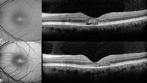 Fundus Autofluorescence Imaging In Macular Telangiectasia Type 2